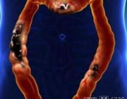 结肠癌晚期症状,揭示生命最后阶段的警示信号